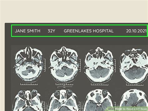 How to Read a CT Scan: 8 Steps (with Pictures) .